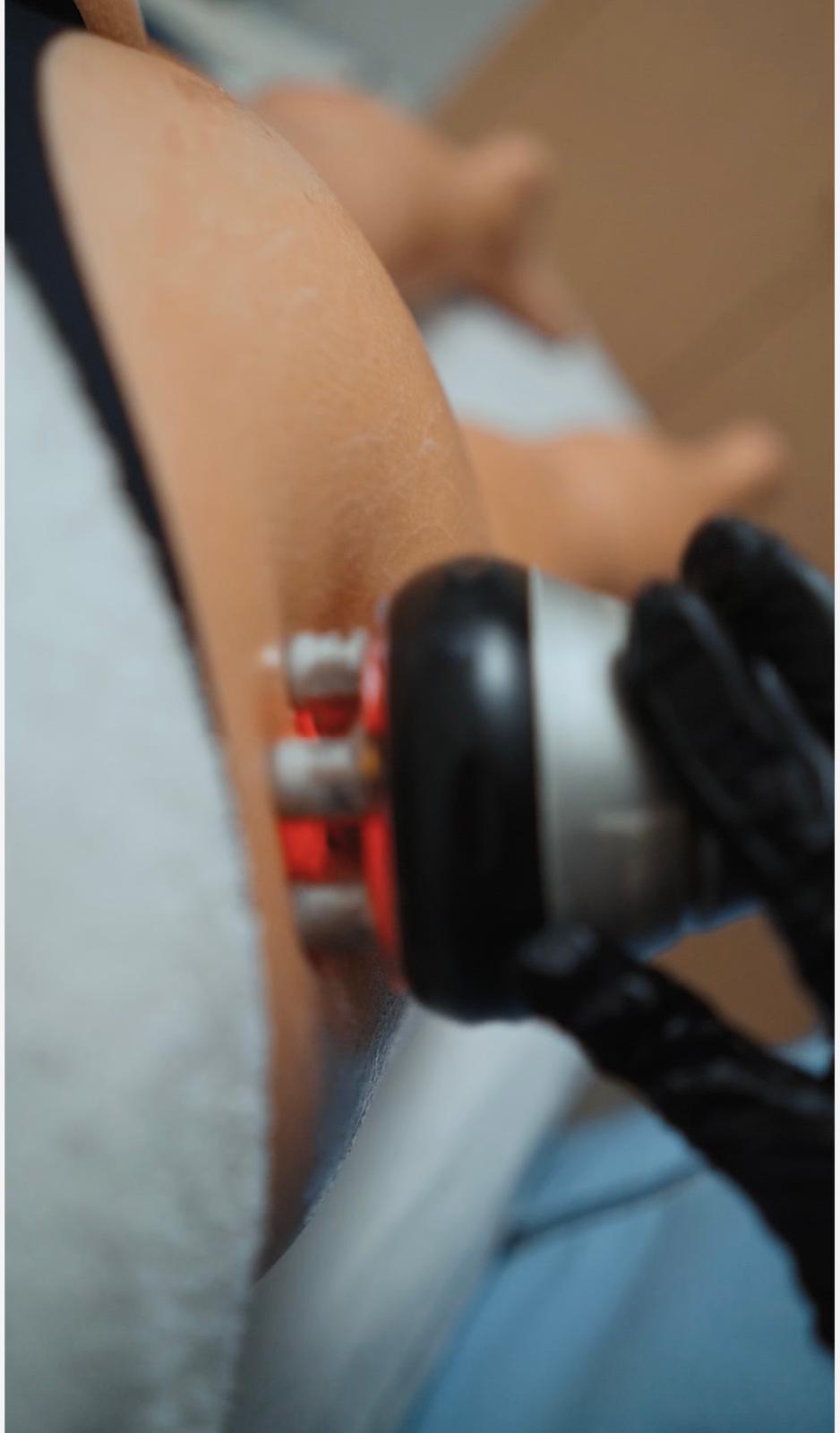 Body Sculpt RF — Radiofrequência Corporal
