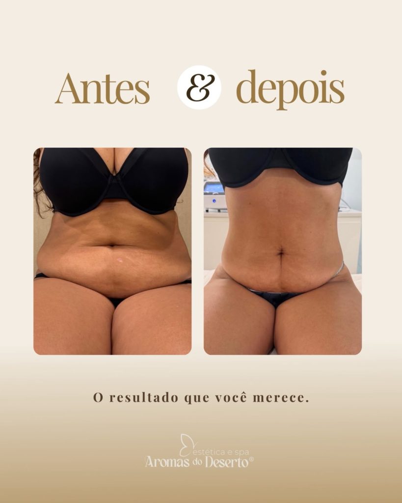 Antes e depois — programa de emagrecimento