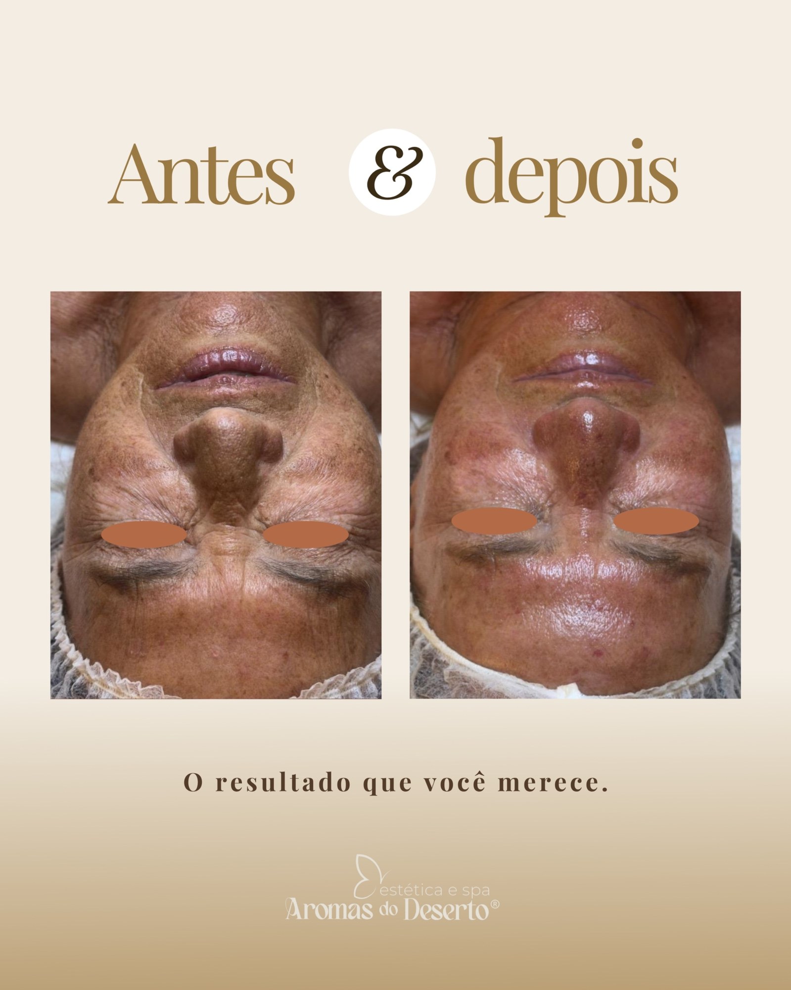Antes e depois — tratamento de pele