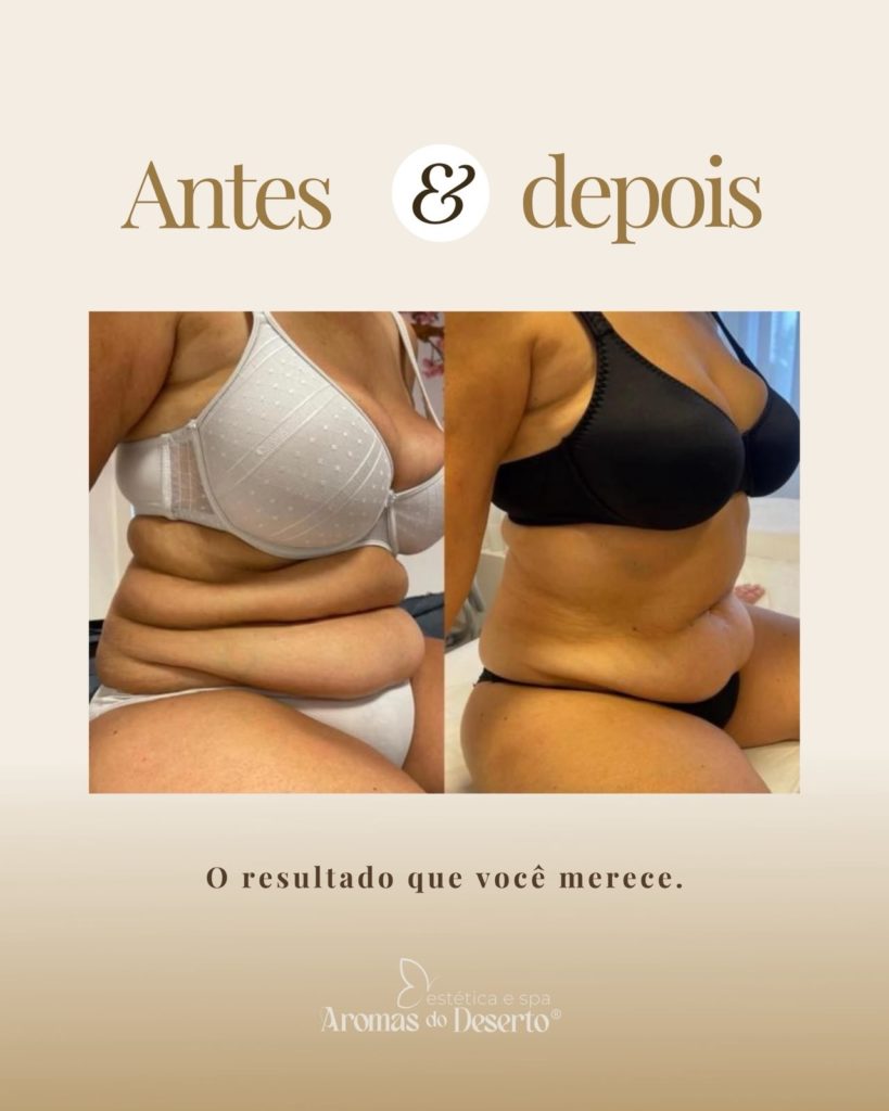 Antes e depois — corpo